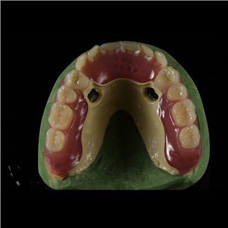 Peek Framework Denture