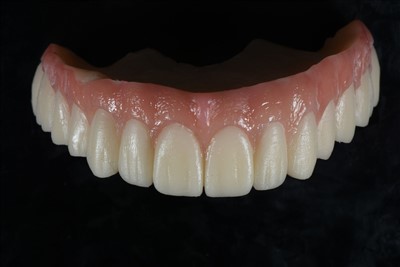 Acryl Resin Temporary Crown