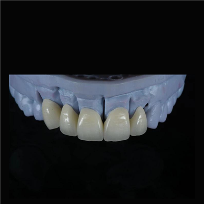 Estetisk och stark Zirconia Crown